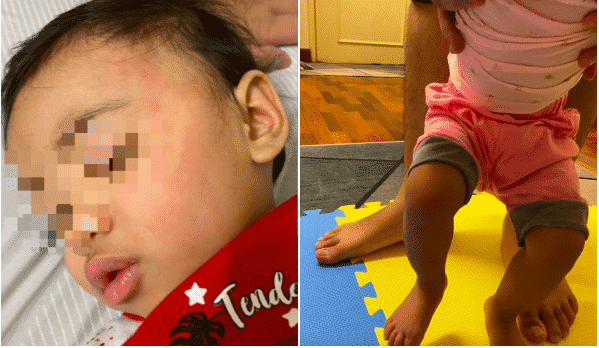Anak luka di muka & kaki retak, ibu pesan hati-hati jika hantar anak taska