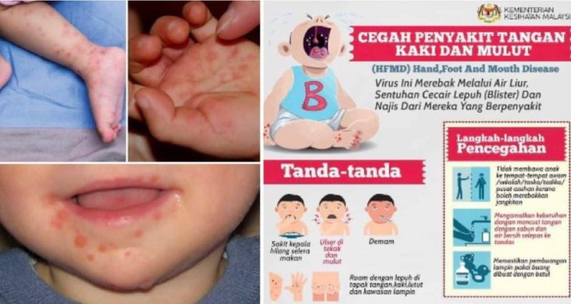 Jangkitan HFMD melepasi paras amaran di Selangor, anak dijangkiti jangan bawa keluar