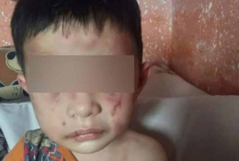 Kanak-kanak 3 tahun cedera disyaki didera penjaga