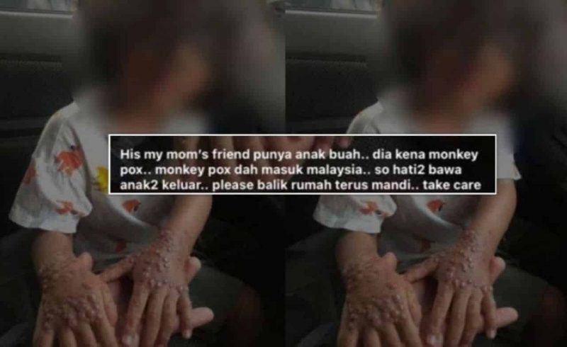 Tular dakwaan Monkeypox dah masuk Malaysia, KKM sahkan belum terima sebarang maklumat